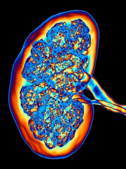 CT Scan of Kidney