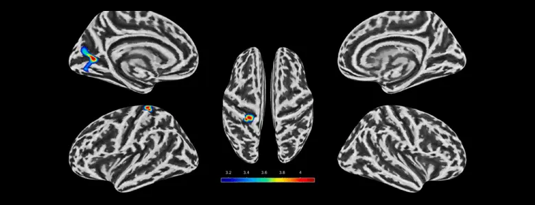 MIR scans reveal cortical thinning, an indicator of healthy brain maturation, in regions involved in visual processing and sensorimotor integration. | Credit: Ma et al., Brain and Cognition