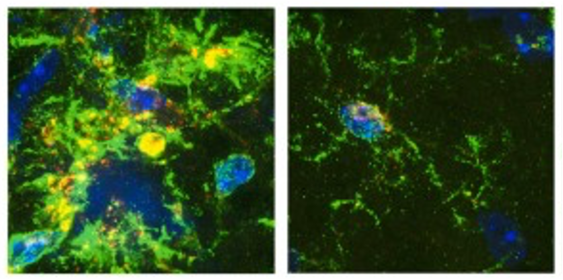 Brain immune cells, microglia (blue) in the brain of mice with Alzheimer’s-like disease. 