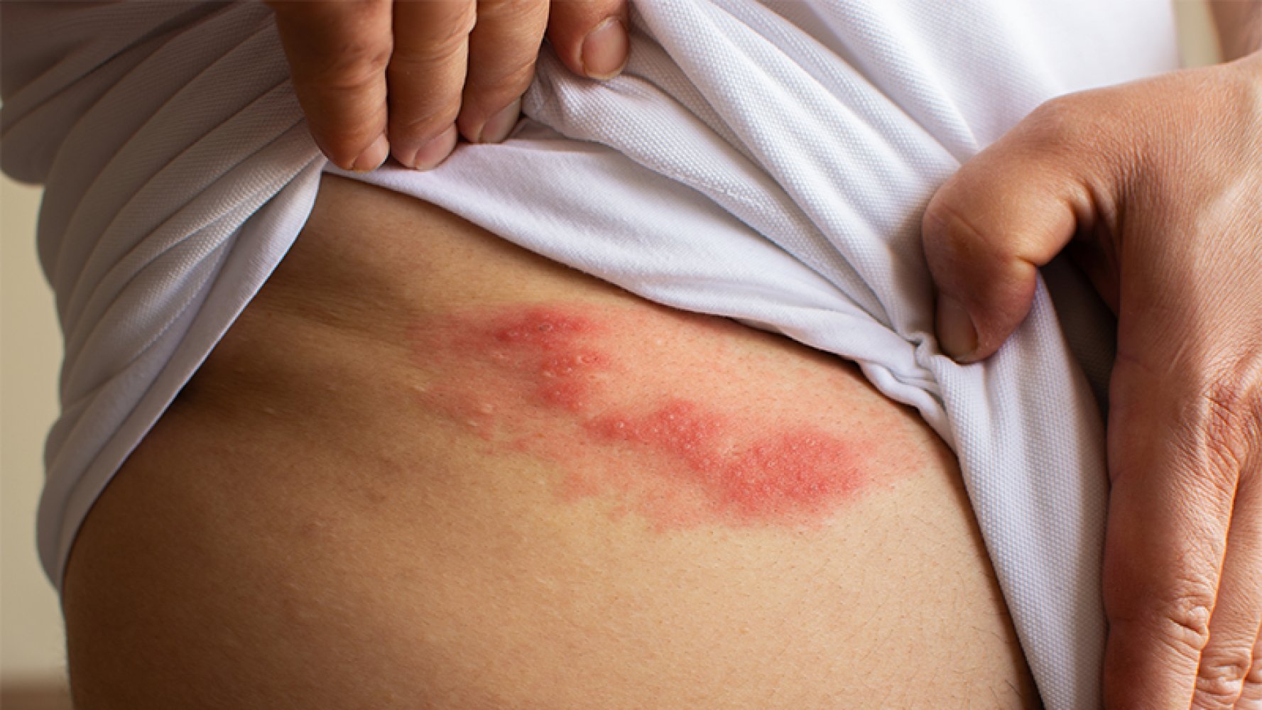 Et utslett med røde blemmer på huden, typisk for helvetesild, vises når personen løfter opp skjorten.