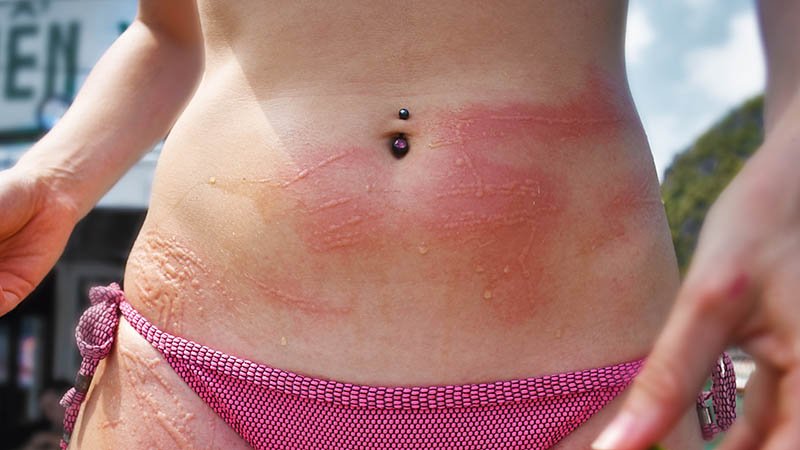 Mage med røde merker og blemmer etter brennmanetstikk