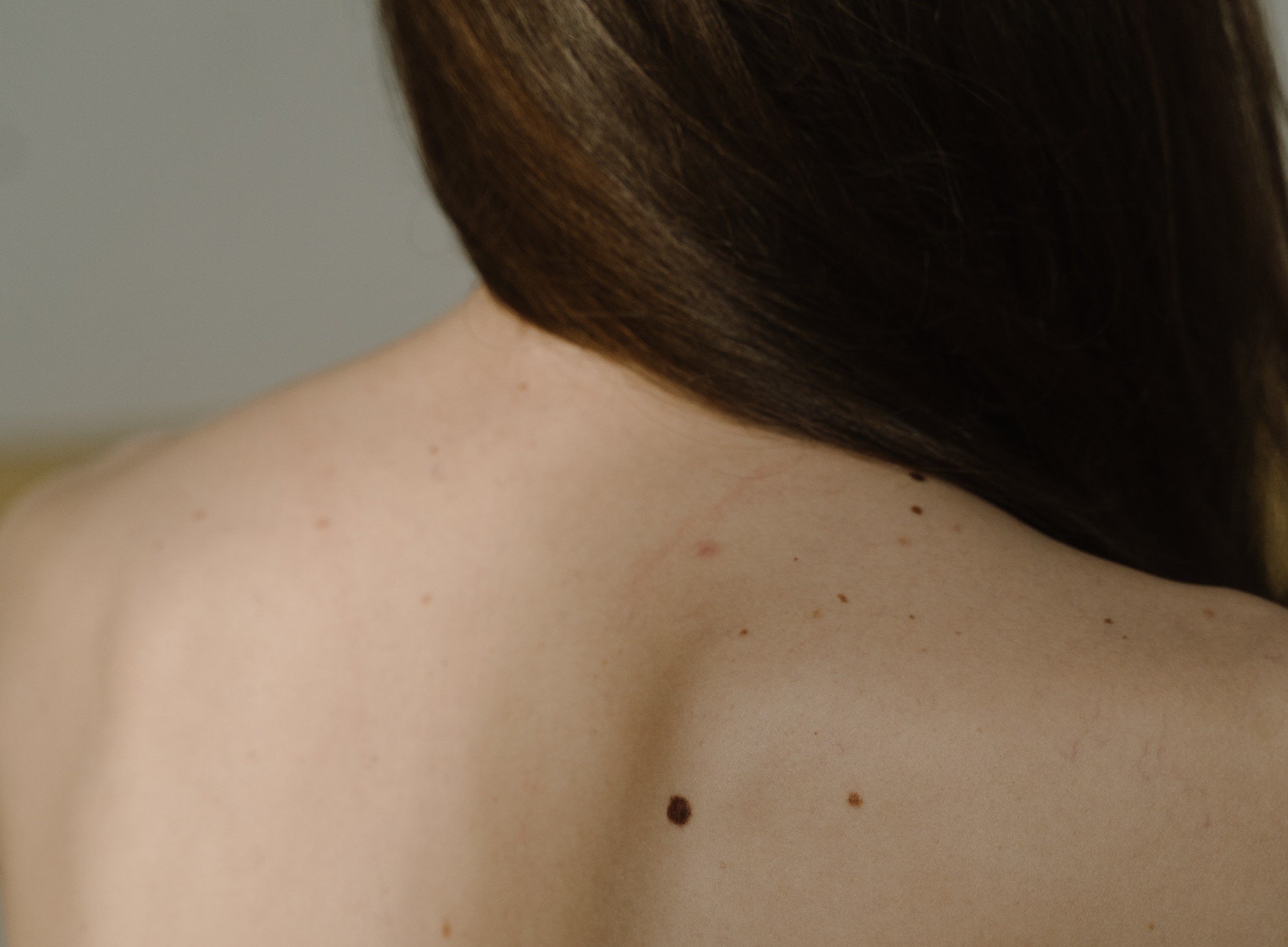 Nærbilde av en rygg med flere føflekker.