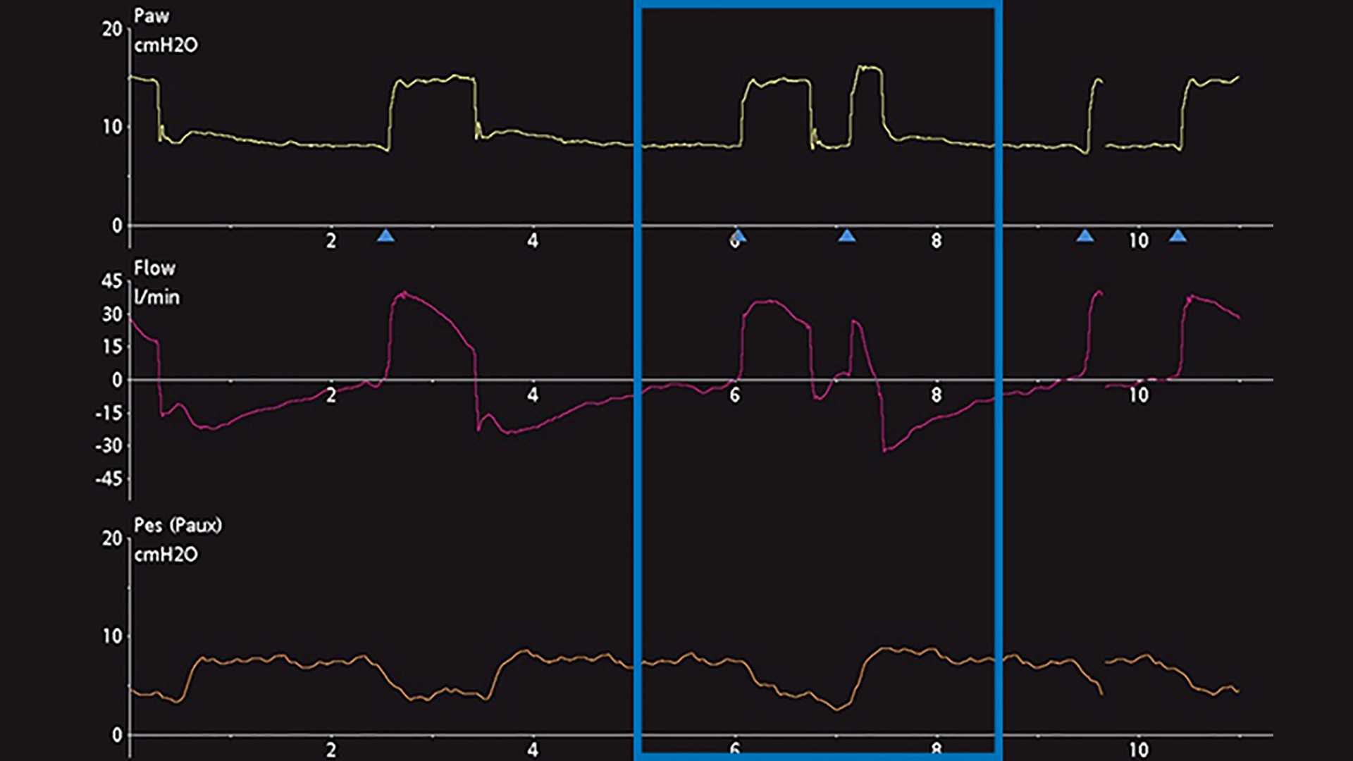Esophageal pressure waveform showing decrease in pleural pressure