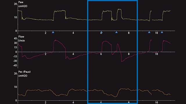 Esophageal pressure waveform showing decrease in pleural pressure