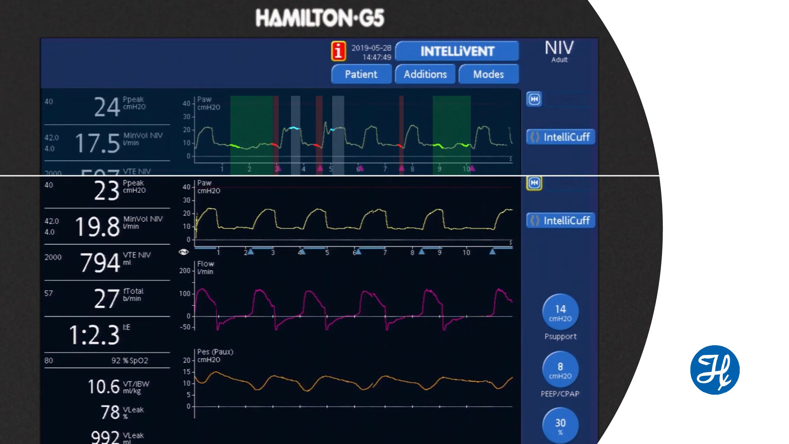 The new IntelliSync+ technology mimics the expert‘s eye by continuously analyzing waveform shapes at least hundred times per second. This allows IntelliSync+ to detect patient efforts immediately, and to initiate inspiration and expiration in real-time. In this video, we demonstrate you the effects of IntelliSync+ on patient-ventilator synchronization on a a real COPD patient in nonvasive ventilation. 00:00 Introduction 00:15 Different types of asynchronies with standard trigger settings 01:48 Synchronization with IntelliSync+ 02:28 Before and after comparison