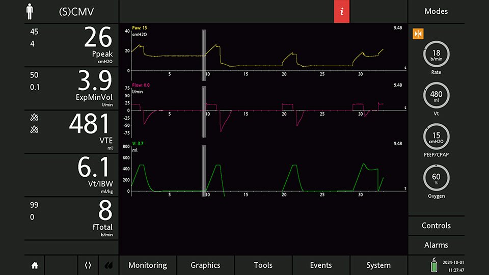 Determining the R/I ratio using the single-breath technique