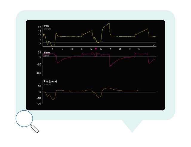 Graph showing a sedated, passively ventilated patient on AC-CMV, monitored with an esophageal balloon.