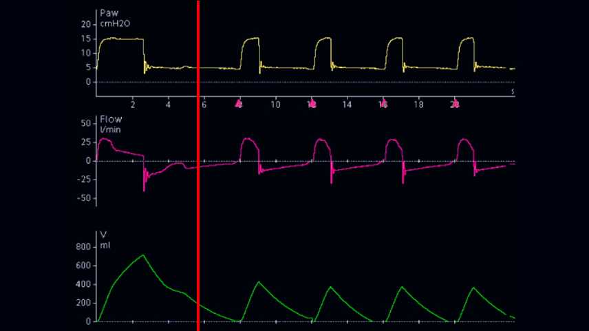 Screenshot of flow waveform when ETS increased