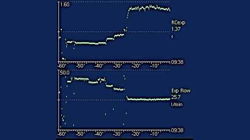 Screenshot showing trends for exp flow and RCecp