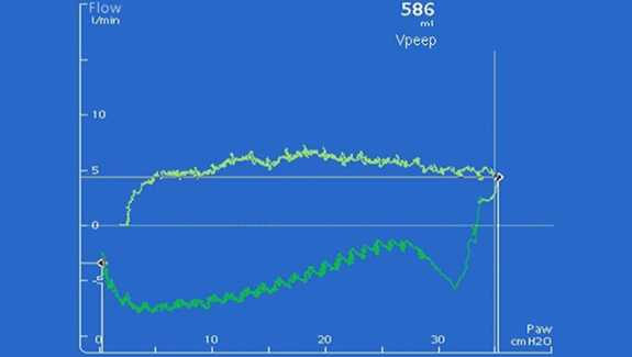 Screenshot of ventilator display showing airway pressure and flow plot
