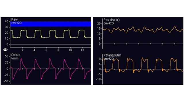 Screenshot showing airway pressure, flow, Pes, and Ptranspulm waveforms