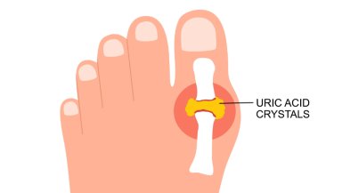 Uric Acid Symptoms- Causes, Warning Signs, Treatment, and Best Ways to Control High Uric Acid Uric Acid Symptoms- Causes, Warning Signs, Treatment, and Best Ways to Control High Uric Acid