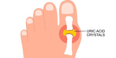 Uric Acid Symptoms- Causes, Warning Signs, Treatment, and Best Ways to Control High Uric Acid Uric Acid Symptoms- Causes, Warning Signs, Treatment, and Best Ways to Control High Uric Acid