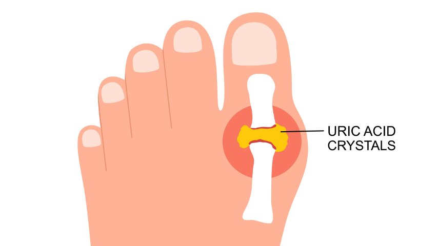 Uric Acid Symptoms- Causes, Warning Signs, Treatment, and Best Ways to Control High Uric Acid Uric Acid Symptoms- Causes, Warning Signs, Treatment, and Best Ways to Control High Uric Acid