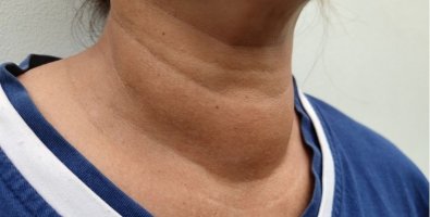 Why Is My Neck Swelling Getting Bigger- Could It Be a Goiter Why Is My Neck Swelling Getting Bigger- Could It Be a Goiter