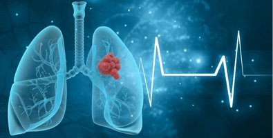 How Accurate Is Transbronchial Lung Biopsy for Diagnosing Lung Disease How Accurate Is Transbronchial Lung Biopsy for Diagnosing Lung Disease