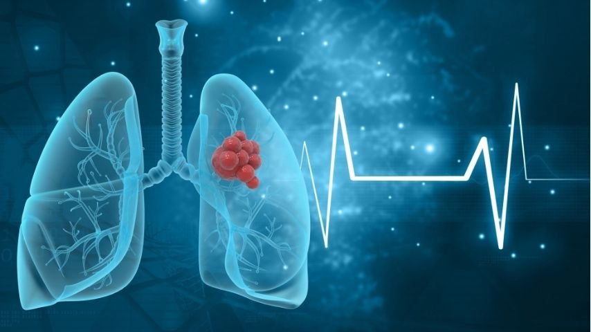 How Accurate Is Transbronchial Lung Biopsy for Diagnosing Lung Disease How Accurate Is Transbronchial Lung Biopsy for Diagnosing Lung Disease