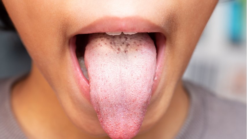 White Tongue- Causes, Symptoms, Treatment, and Best Ways to Get Relief