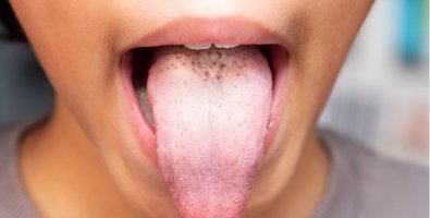 White Tongue- Causes, Symptoms, Treatment, and Best Ways to Get Relief White Tongue- Causes, Symptoms, Treatment, and Best Ways to Get Relief