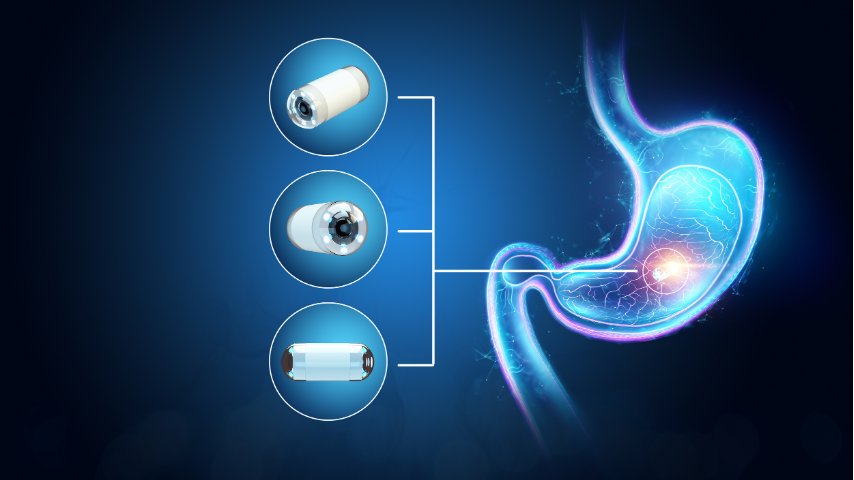 Is Capsule Endoscopy Safe-Understanding the Real Risk of Capsule Retention