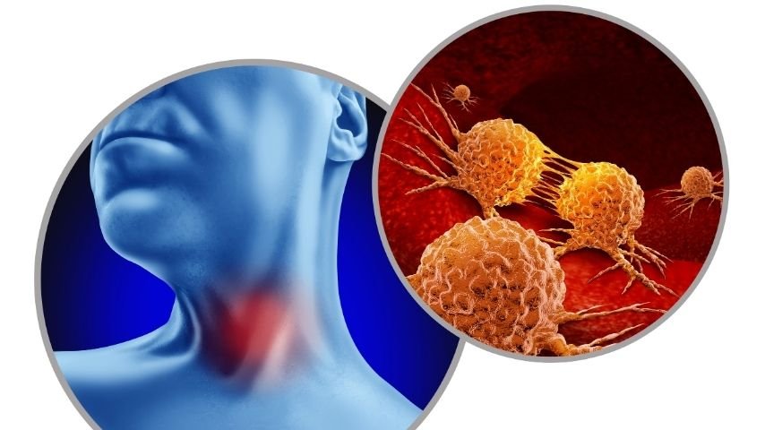 Treatment Options for HPV-Related Head & Neck Cancer- Surgery, Radiation, or Both Treatment Options for HPV-Related Head & Neck Cancer- Surgery, Radiation, or Both