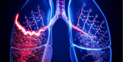 Is a CT-Guided Lung Biopsy Painful-What Patients Actually Experience Is a CT-Guided Lung Biopsy Painful-What Patients Actually Experience