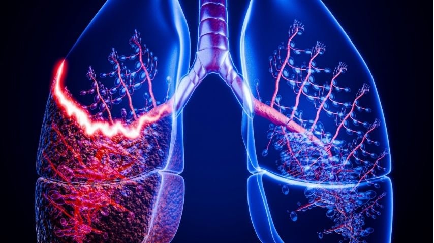 Is a CT-Guided Lung Biopsy Painful-What Patients Actually Experience Is a CT-Guided Lung Biopsy Painful-What Patients Actually Experience