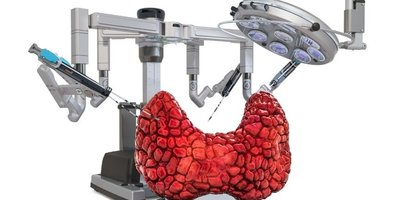 Am I Eligible for Robotic Thyroidectomy or Is My Doctor Right to Say No Am I Eligible for Robotic Thyroidectomy or Is My Doctor Right to Say No