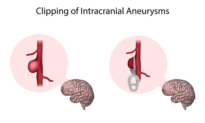 How a brain aneurysm is treated through surgical clipping brain-aneurysm-surgical-clipping