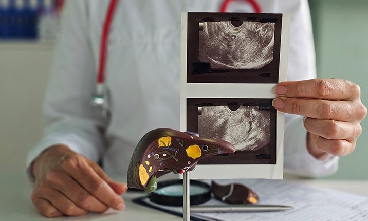 fatty-liver-screening