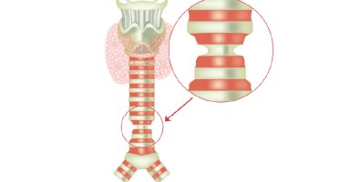 Balloon Dilatation vs Airway Stenting-Which Treatment Is Right for Tracheal Stenosis Balloon Dilatation vs Airway Stenting-Which Treatment Is Right for Tracheal Stenosis