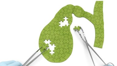 Diet and Lifestyle After Gallbladder Removal-Real Advice for Long-Term Wellness Diet and Lifestyle After Gallbladder Removal-Real Advice for Long-Term Wellness