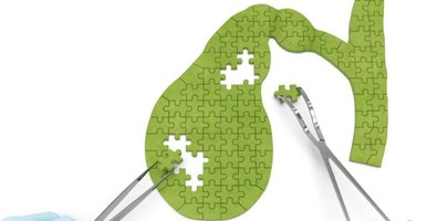 Diet and Lifestyle After Gallbladder Removal-Real Advice for Long-Term Wellness Diet and Lifestyle After Gallbladder Removal-Real Advice for Long-Term Wellness