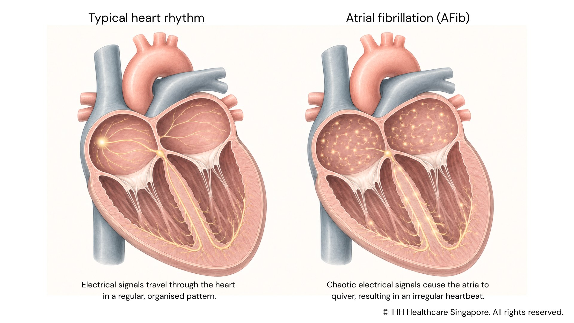 What is atrial fibrillation (Afib)?