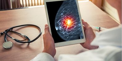 Deciding Between Immediate Reconstruction or Delayed Reconstruction After Mastectomy Deciding Between Immediate Reconstruction or Delayed Reconstruction After Mastectomy