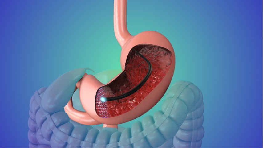 Why Did My Doctor Take a Biopsy During Endoscopy- Understanding Results, Reports, and Next Steps
