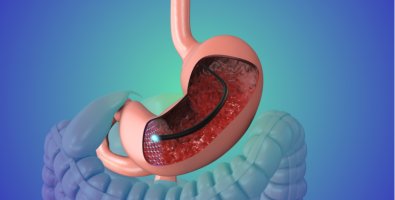 Why Did My Doctor Take a Biopsy During Endoscopy- Understanding Results, Reports, and Next Steps Why Did My Doctor Take a Biopsy During Endoscopy- Understanding Results, Reports, and Next Steps