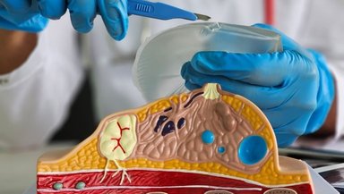 Who Is a Good Candidate for Oncoplastic Breast Reconstruction- Size, Tumor Location, and Breast Shape Explained Who Is a Good Candidate for Oncoplastic Breast Reconstruction- Size, Tumor Location, and Breast Shape Explained