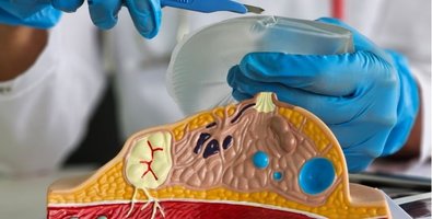 Who Is a Good Candidate for Oncoplastic Breast Reconstruction- Size, Tumor Location, and Breast Shape Explained Who Is a Good Candidate for Oncoplastic Breast Reconstruction- Size, Tumor Location, and Breast Shape Explained