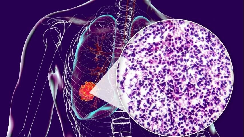 CT Scan Found a Lung Nodule- Does It Always Mean Cancer
