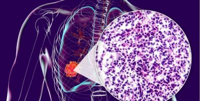 CT Scan Found a Lung Nodule- Does It Always Mean Cancer CT Scan Found a Lung Nodule- Does It Always Mean Cancer