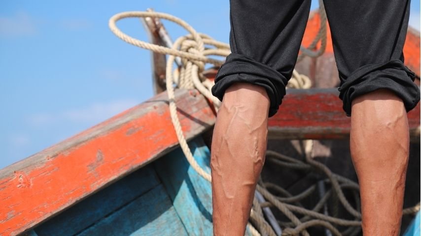 Will Varicocele Embolization Improve Fertility- What Real Outcomes Show