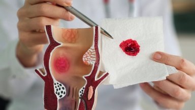 How Painful Is Hemorrhoidectomy Really- What Patients Should Know Before Saying No to Surgery How Painful Is Hemorrhoidectomy Really- What Patients Should Know Before Saying No to Surgery