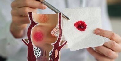 How Painful Is Hemorrhoidectomy Really- What Patients Should Know Before Saying No to Surgery How Painful Is Hemorrhoidectomy Really- What Patients Should Know Before Saying No to Surgery