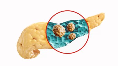 Why Is My Distal Pancreatectomy Recovery So Slow- Common Reasons and What’s Normal Why Is My Distal Pancreatectomy Recovery So Slow- Common Reasons and What’s Normal