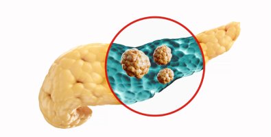 Why Is My Distal Pancreatectomy Recovery So Slow- Common Reasons and What’s Normal Why Is My Distal Pancreatectomy Recovery So Slow- Common Reasons and What’s Normal