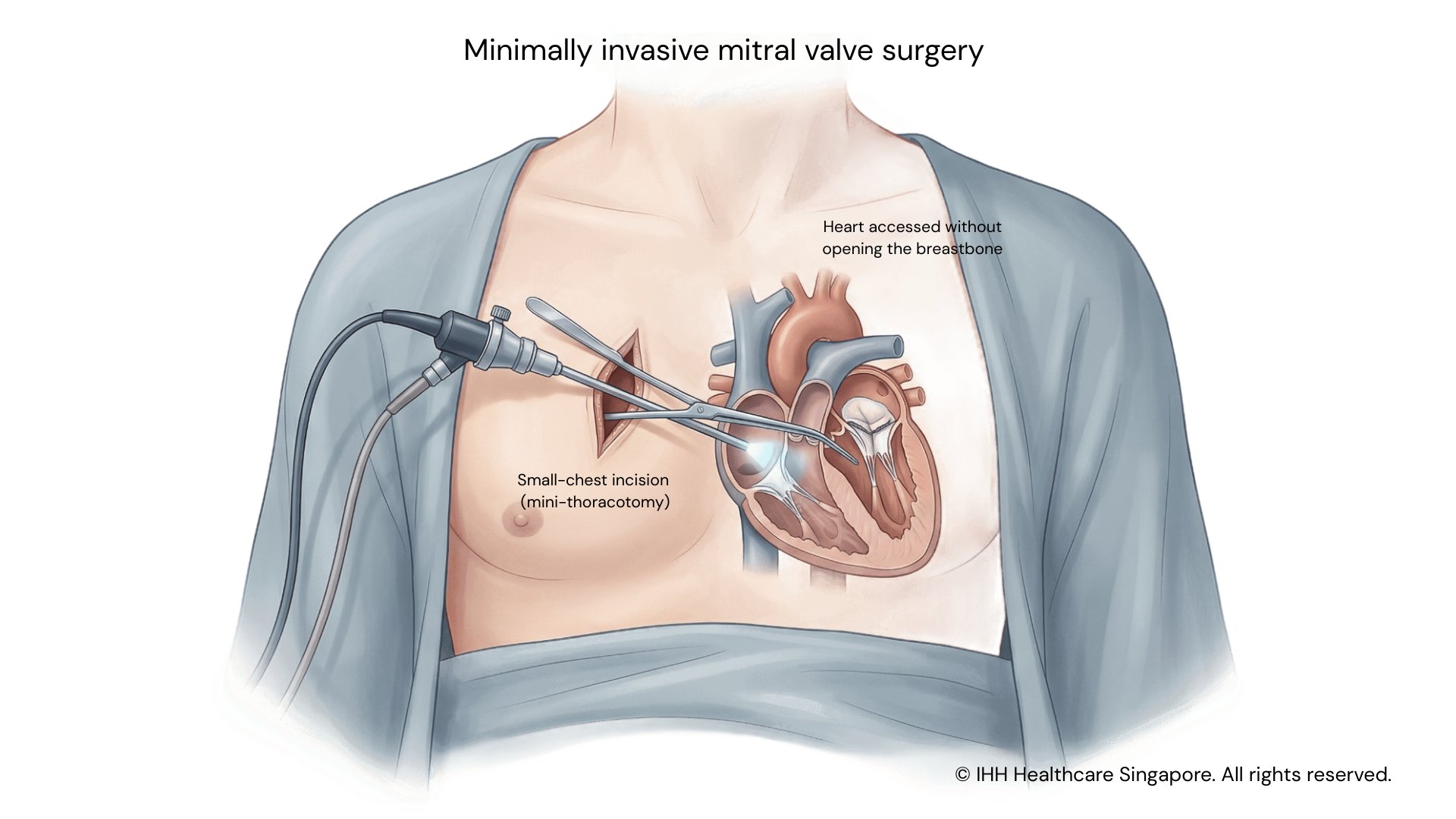 Minimally invasive mitral valve surgery_1920x1080