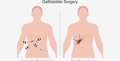 Laparoscopic vs Open Cholecystectomy-Pros, Cons, and Recovery Expectations Laparoscopic vs Open Cholecystectomy-Pros, Cons, and Recovery Expectations