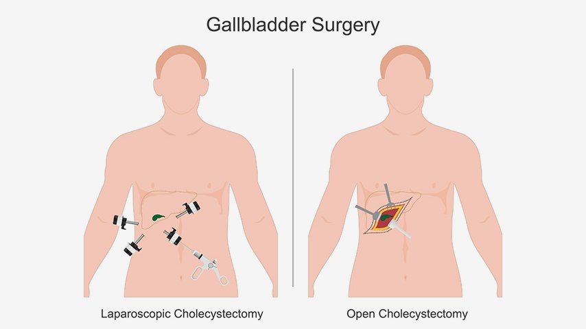 Laparoscopic vs Open Cholecystectomy-Pros, Cons, and Recovery Expectations Laparoscopic vs Open Cholecystectomy-Pros, Cons, and Recovery Expectations