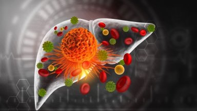 Can Advanced Liver Cancer Become Operable- Downstaging Treatments Explained Can Advanced Liver Cancer Become Operable- Downstaging Treatments Explained
